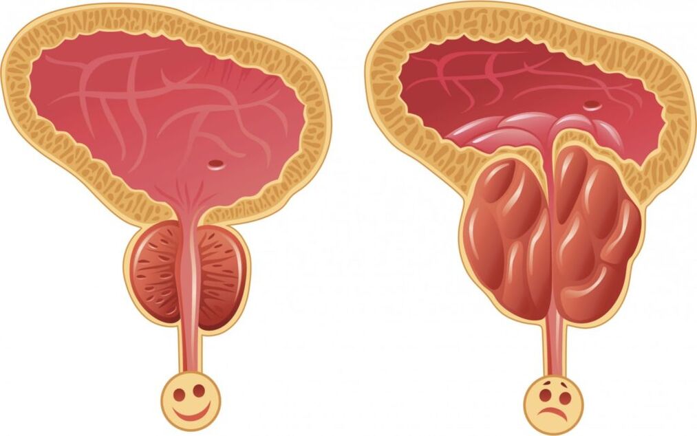 simptome de prostatita la barbati